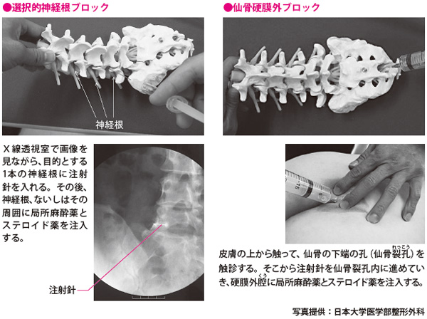 仙骨 ブロック 注射