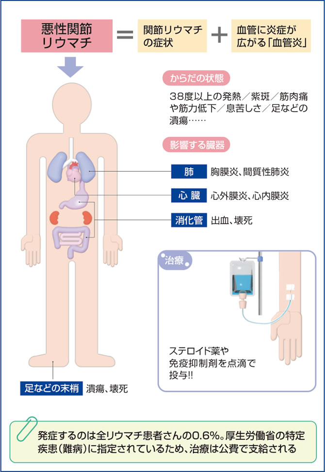 関節 リウマチ 難病