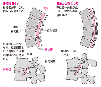 検査と診断 治療法の選択 診断と治療法の決定 腰部脊柱管狭窄症 治療と予防 痛みの原因と治療法 Qlife痛み