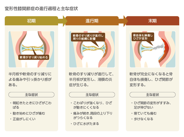 性 膝 関節 症 変形 「変形性膝関節症」｜日本整形外科学会 症状・病気をしらべる