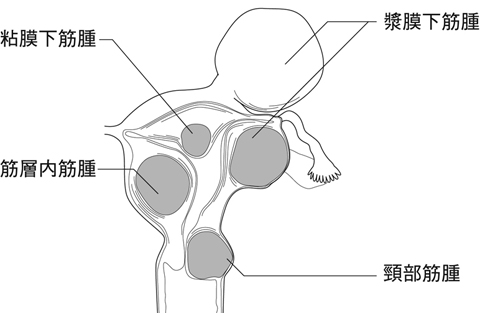 図９　子宮筋腫の発生部位