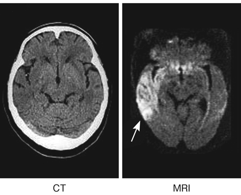 図３　脳梗塞のCT像とMRI像