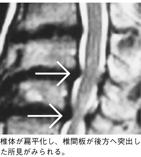 図24　頸椎症（MRI像）