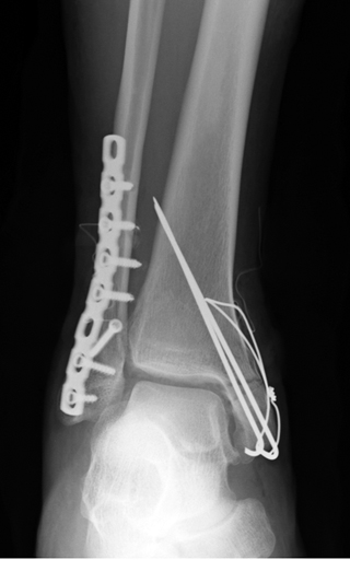 脛骨遠位部骨折 足関節骨折とは 医療総合qlife