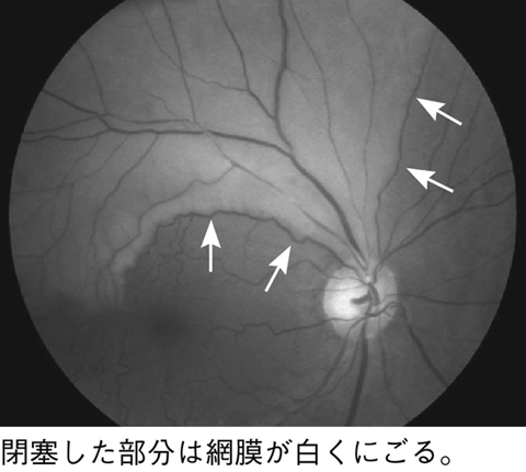 図38　網膜動脈閉塞症
