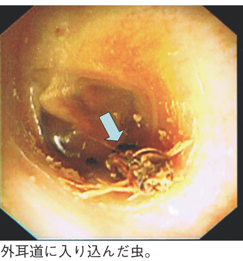 外耳道異物 耳の病気 外耳の病気 とは 医療総合qlife