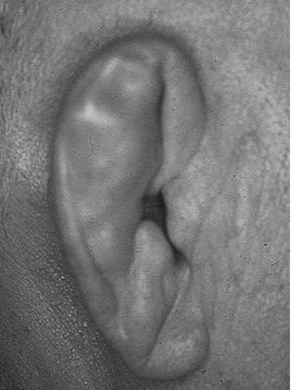図11　耳介軟骨膜炎による耳介の変形