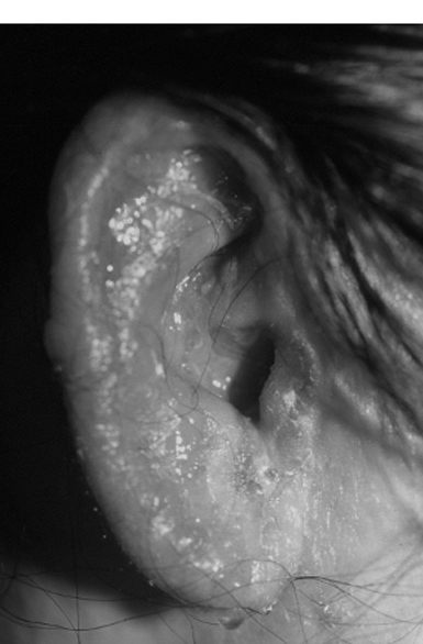 外耳道湿疹とは 医療総合qlife