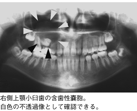 含歯性嚢胞 濾胞性歯嚢胞 とは 医療総合qlife