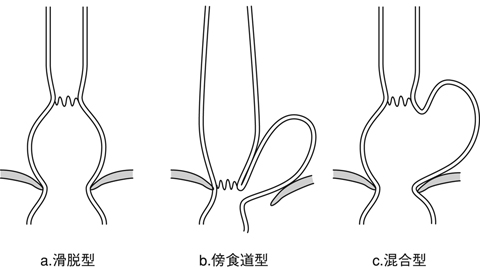 図５　食道裂孔ヘルニア（Zainoの分類）