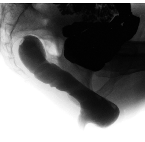 図４　直腸瘤（排便造影）