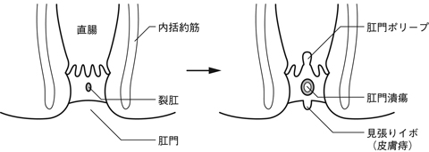 図14　裂肛と肛門潰瘍