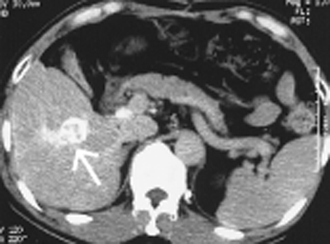 図12　肝細胞がん（X線CT像）