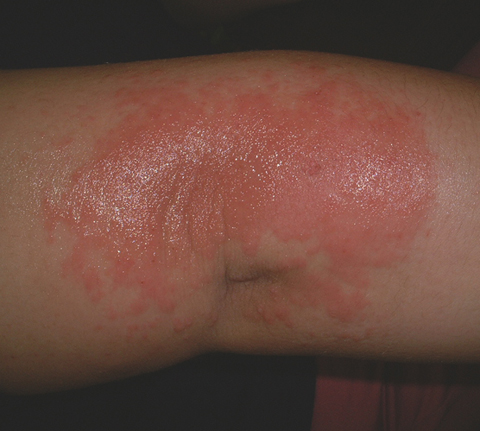 図１　外用薬による接触皮膚炎
