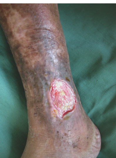 図15　下腿潰瘍