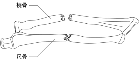前腕骨骨折とは 医療総合qlife