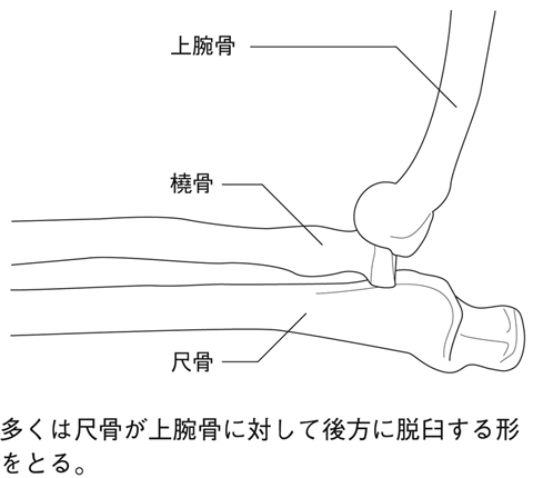 肘関節脱臼とは 医療総合qlife