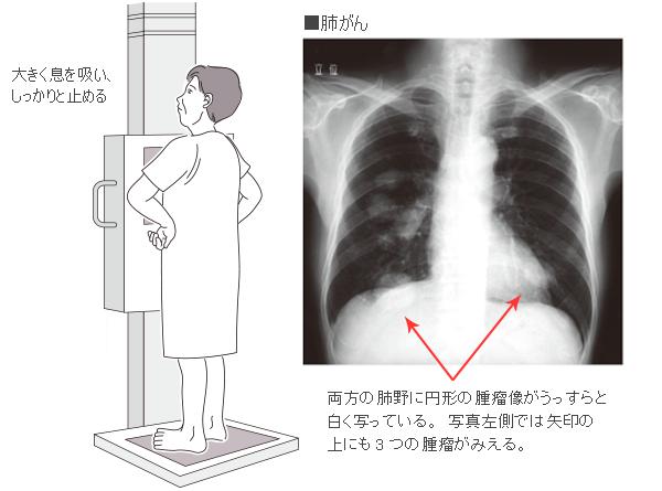 胸部単純x線撮影検査とは 病気の検査法を調べる 医療総合qlife