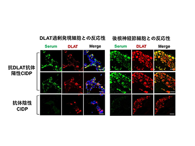 CIDPの新たな自己抗体を発見、感覚神経障害のバイオマーカーになる可能性