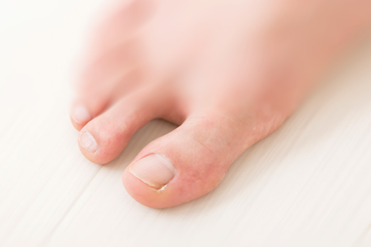 推定患者数1000万人以上 爪水虫 爪白癬 の症状 原因 治療法は 医療総合qlife
