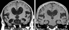 特発性正常圧水頭症の画像的特徴（MRI）