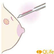 組織診　針生検（バネ式生検）