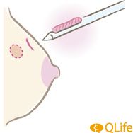 組織診　マンモトーム生検