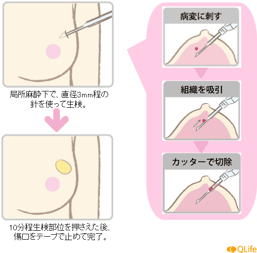 マンモトーム生検の方法