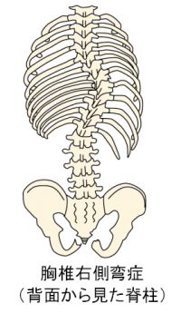 胸椎右側側湾症